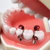 20 Pièces/boîte Système de Matrice Sectionnelle Dentaire Matrice de Protection des Dents Adjacentes Matrices de Type Déflecteur Autoclavable Matériaux de Dentisterie